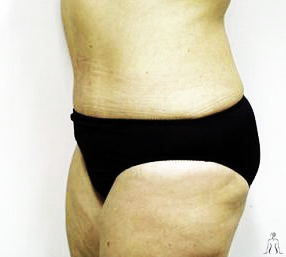 Cosmetic Surgery in Tunisia Tummy Tuck or Abdominoplasty 