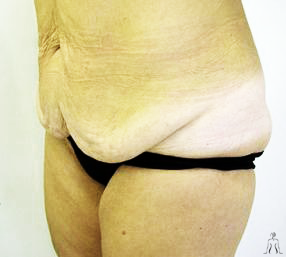Cosmetic Surgery in Tunisia Tummy Tuck or Abdominoplasty 