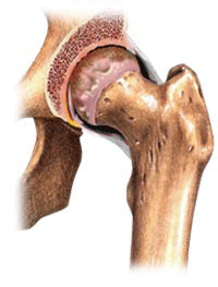 Orthopedic surgery in Tunisia - Hip prosthesis