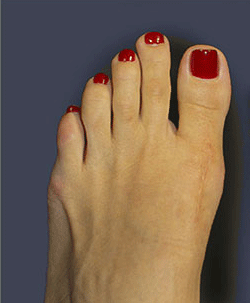 Orthopedic surgery in Tunisia - Bunion