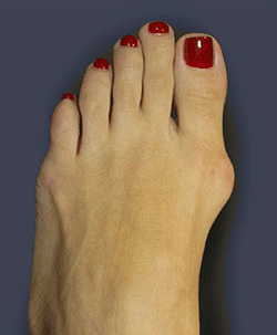 Orthopedic surgery in Tunisia - Bunion