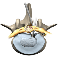 Orthopedic surgery in Tunisia - lumbar disc