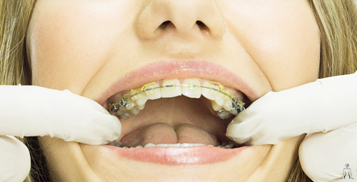 Dental Surgery in Tunisia - Orthodontics